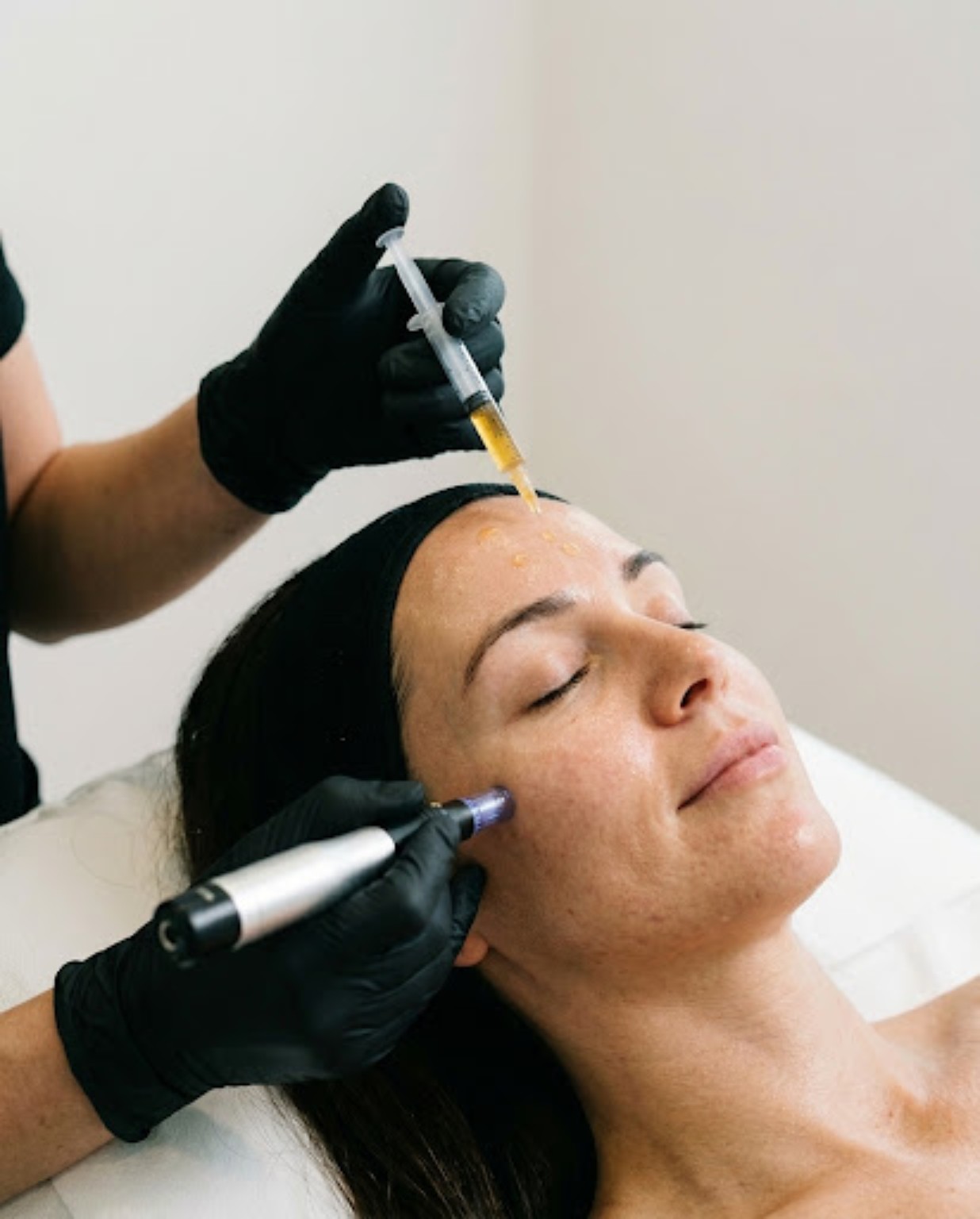 Tratamiento facial con plasma y Dermapen