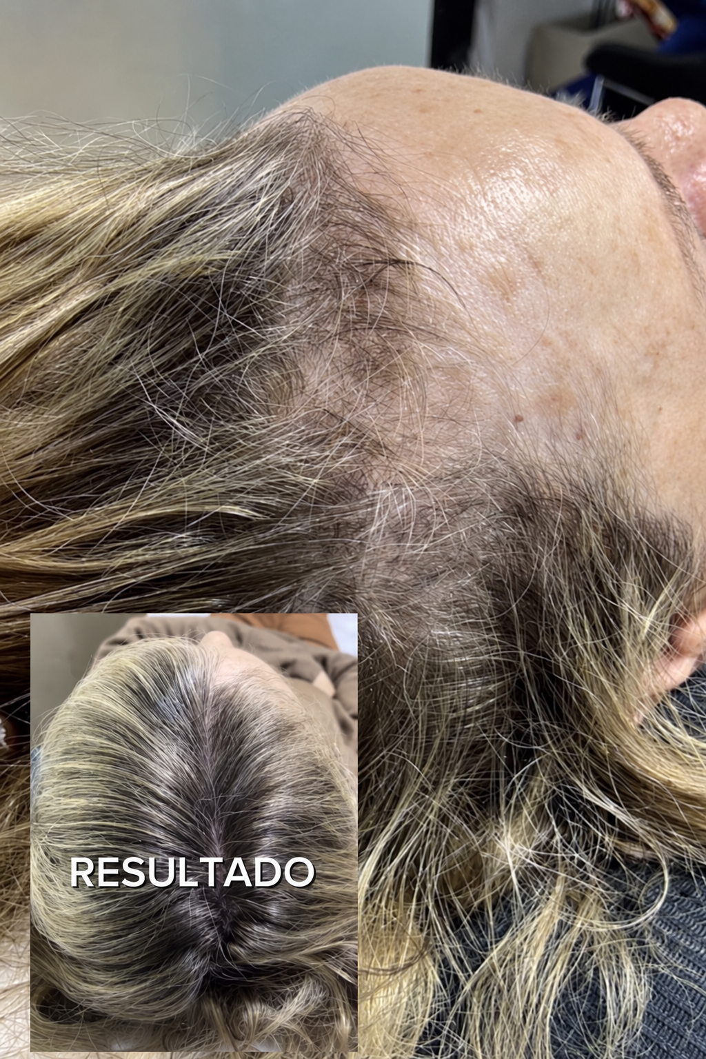 Antes y después de cinco sesiones capilares