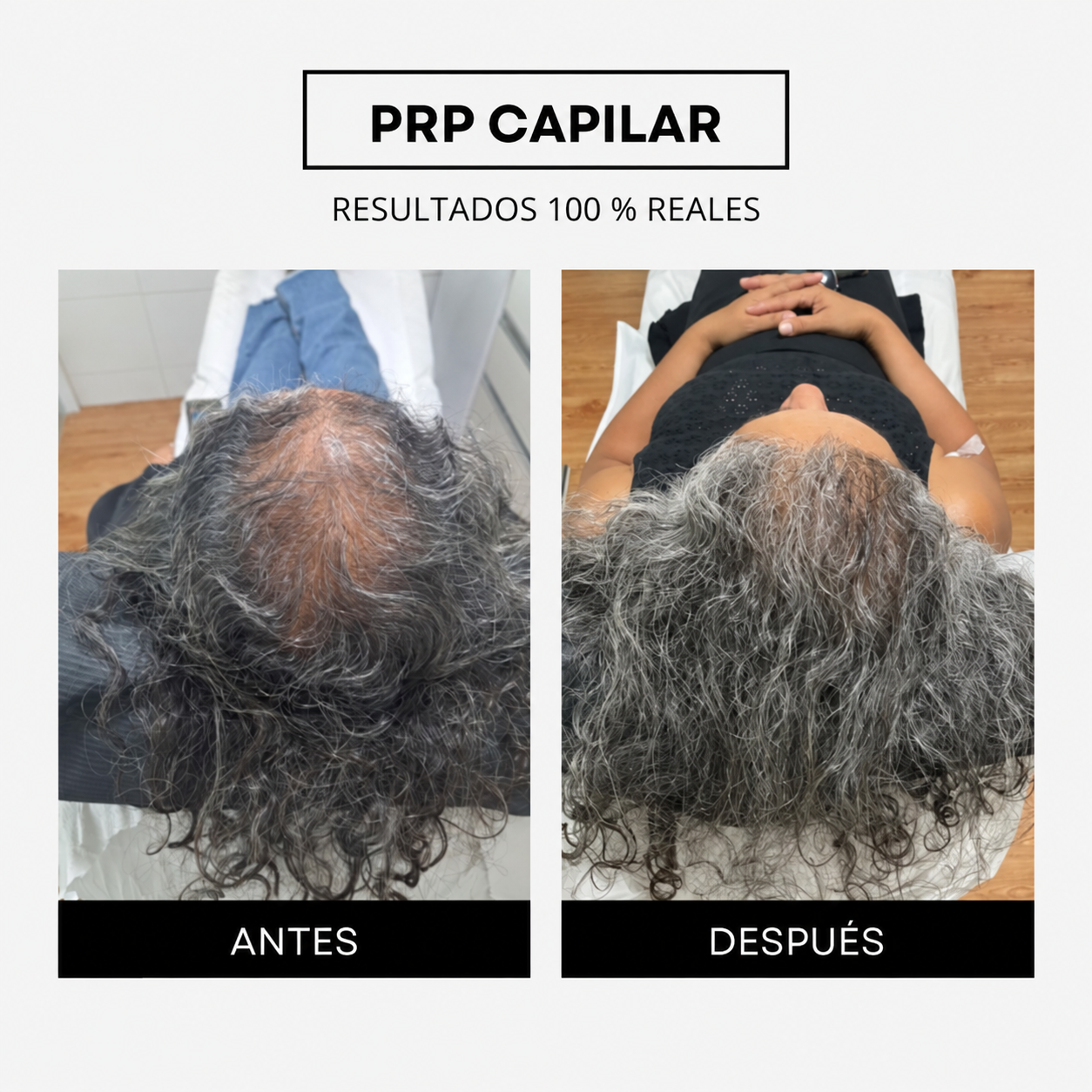 Antes y después capilar luego de siete sesiones